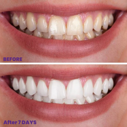 DentalX PAP+ Teeth Whitening Strips - Advanced Whitening Formula